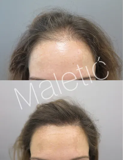 Na transplantaciju se rjeđe odlučuju žene/Foto: Ana Maletić