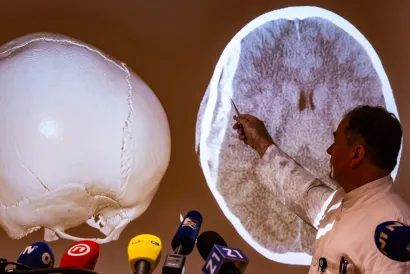 Detalj s konferencije na kojoj su prikazane teške ozljede djece i adolescenata uslijed padova s elektricčnih romobila/Foto: Darko Tomaš/CROPIX